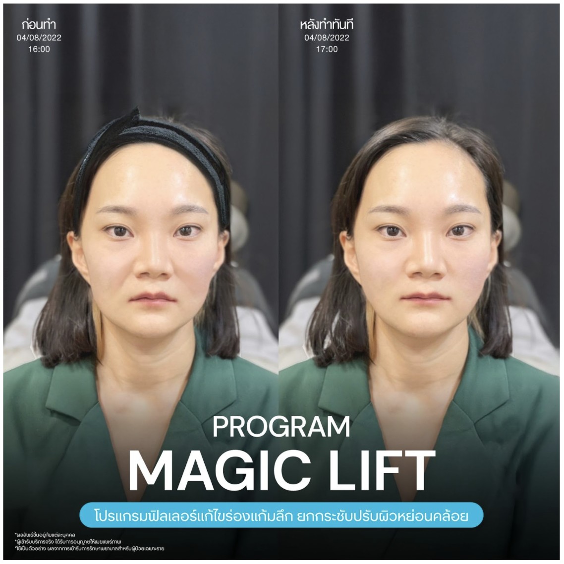 แก้ปัญหาร่องแก้ม