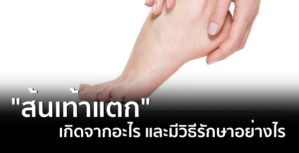 "ส้นเท้าแตก" เกิดจากอะไร และมีวิธีรักษาอย่างไร