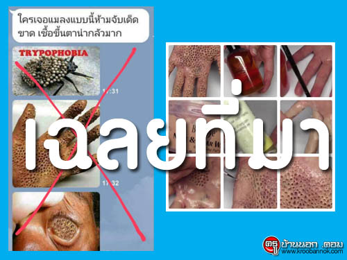 ที่มาภาพมือเป็นรู ที่แชร์กันให้กลัวกันทั่วไลน์ ที่แท้มาจาก....