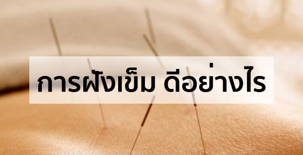 การฝังเข็ม ดีอย่างไร