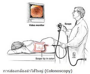 ภัยเงียบ...มะเร็งลำไส้ใหญ่...... 