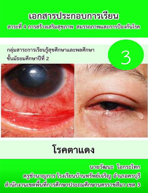 เอกสารประกอบการเรียน สาระที่ 4 การสร้างเสริมสุขภาพ สมรรถภาพและการป้องกันโรค เรื่อง โรคตาแดง ผลงานครูวัฒนะ โอกระโทก