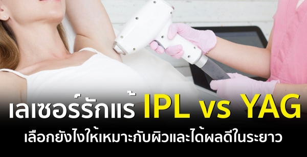 เลเซอร์รักแร้ IPL vs YAG เลือกยังไงให้เหมาะกับผิวและได้ผลดีในระยาว