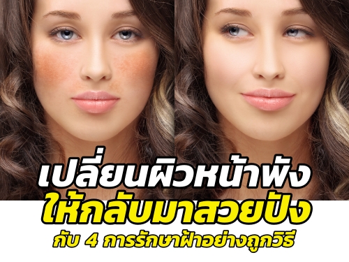 เปลี่ยนผิวหน้าพังให้กลับมาสวยปังกับ 4 การรักษาฝ้าอย่างถูกวิธี